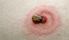 How Dangerous are Tick Bites in Northern Beaches?